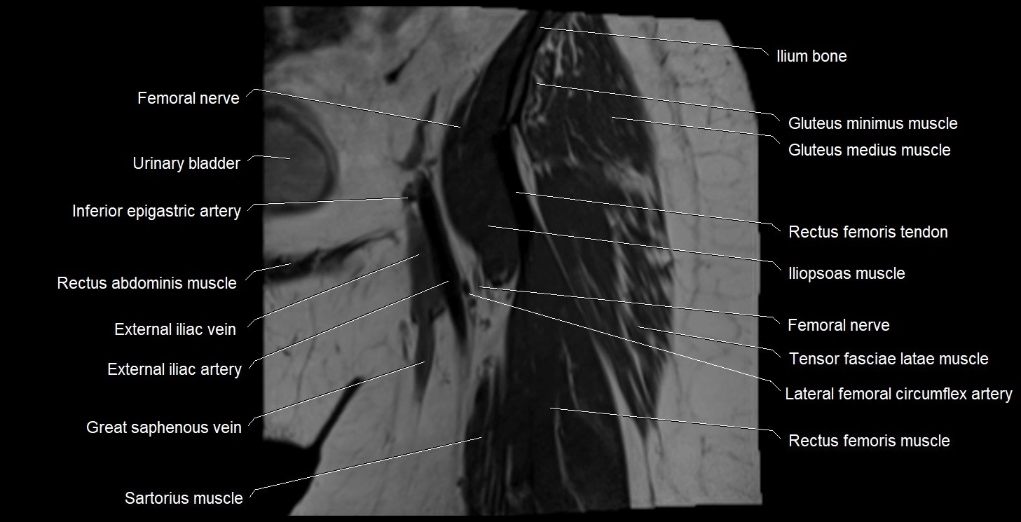 MRI Hip 3T coronal cross sectional anatomy image 9.webp